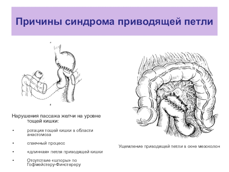 Анастомоз по ру схема