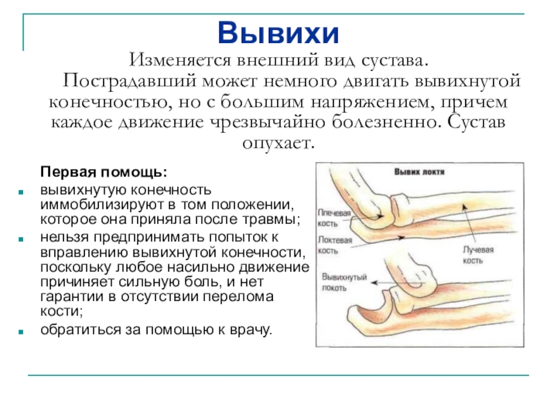 Вывихнуть. Вывихивающие движения.