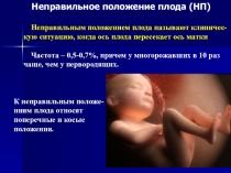 Неправильное положение плода (НП)
Неправильным положением плода называют