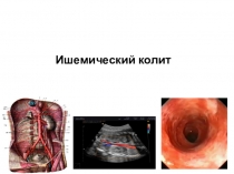 Ишемический колит
