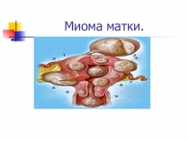 Миома матки