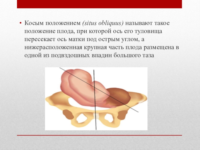 Оси зародыша. Косое положения плода в матке. Ось матки под острым углом.