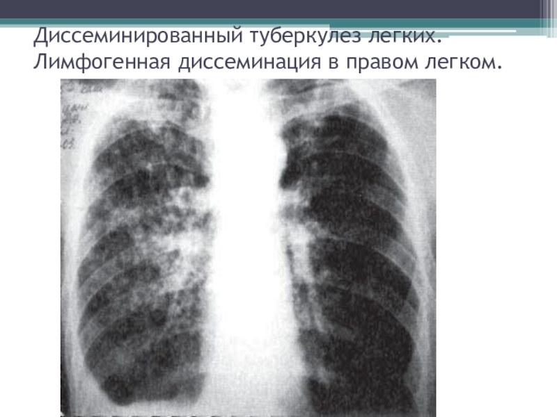 Формы диссеминированного туберкулеза. Милиарный диссеминированный туберкулез. Милиарный диссеминированный туберкулез рентген. Лимфогенный диссеминированный туберкулез рентген. Лимфогенный диссеминированный туберкулез легких это.