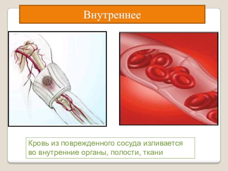 Кровь из поврежденного сосуда изливается во внутренние органы, полости, тканиВнутреннее