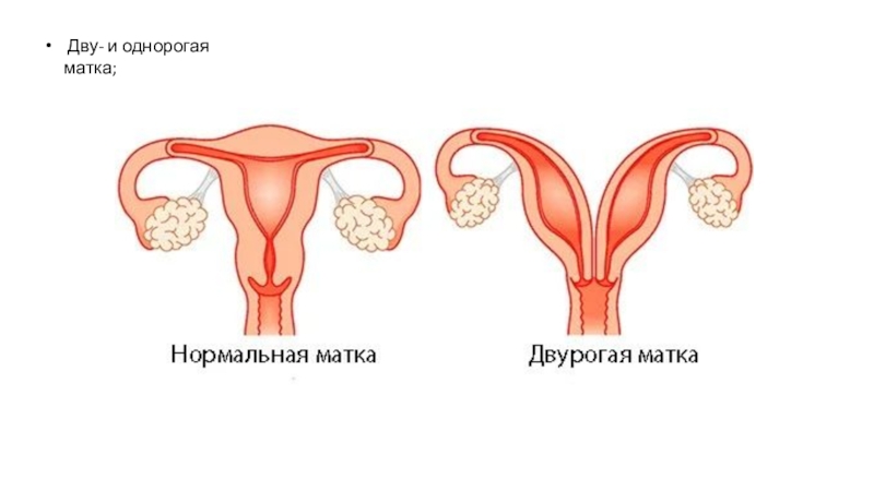 Дву. Двойная и двурогая матка. Двурогая матка с двумя шейками. Двурогая матка и нормальная матка. Двурогая матка с рудиментарным рогом.