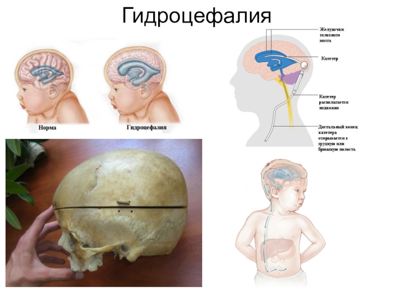 Причины гидроцефалии головного мозга