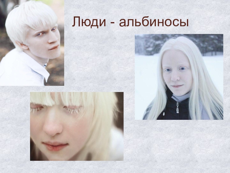 Альбинизмом страдают. Глазокожный альбинизм 4 типа. Альбинизм наследственное заболевание. Генетические заболевания альбинизм.