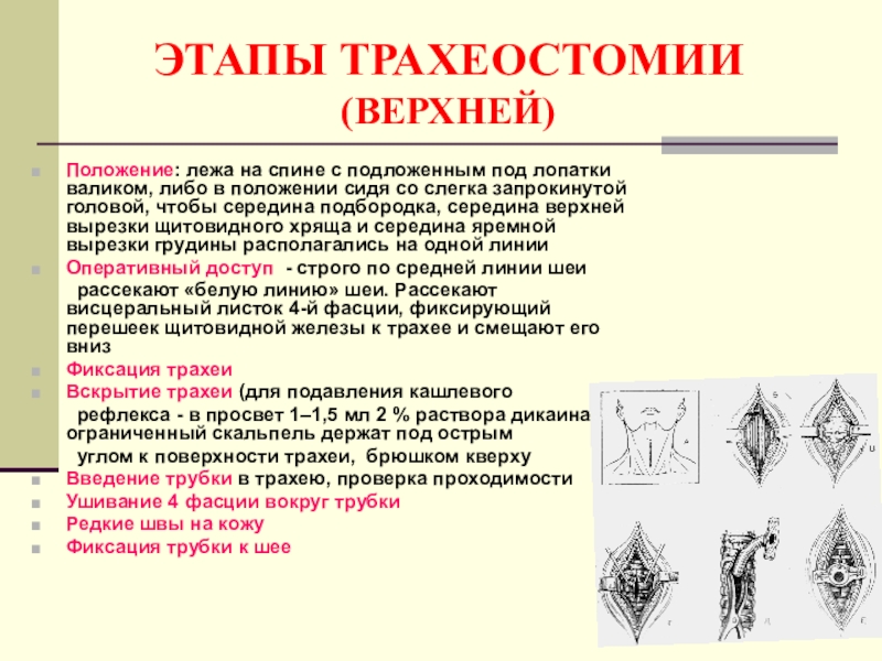 Верхнее положение. Трахеостомия верхняя средняя нижняя. Положение скальпеля при трахеостомии. Оперативный доступ трахеостомии.