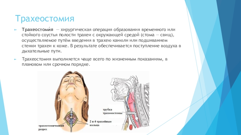 Постановка трахеостомы. Осложнения операции трахеостомии. Ранние осложнения трахеостомии. Введение канюли в трахею.