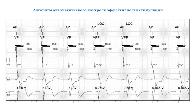 Автоматический алгоритм. Алгоритм расшифровки ЭКГ. Алгоритм холтеровского мониторирования. Автоматическое распознавание ЭКГ. Алгоритм расшифровки ЭКГ по пунктам.