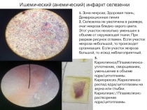 Ишемический (анемический) инфаркт селезенки