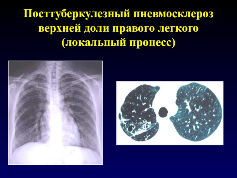 Легочный рисунок с признаками пневмосклероза