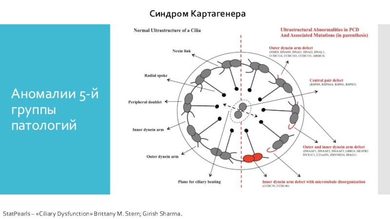 Синдром картагенера презентация