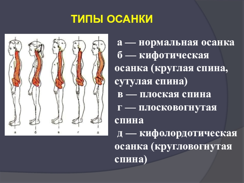 Как называется нарушение осанки изображенное на рисунке