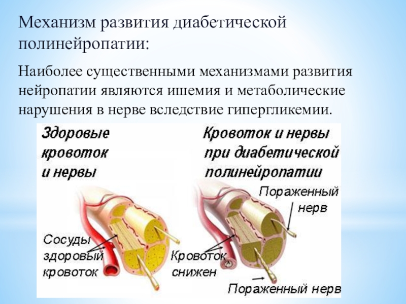 Диабетическая полинейропатия презентация