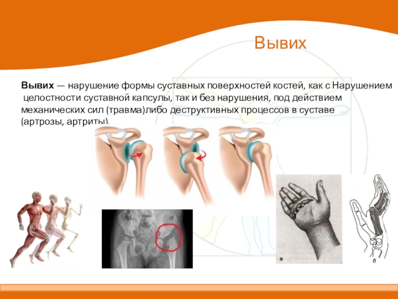 Растяжение связок презентация