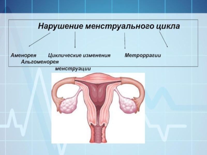 Реферат: Меноррагия (гиперменорея, обильные менструации)