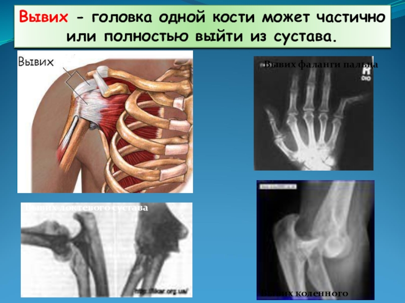 Растяжение связок презентация