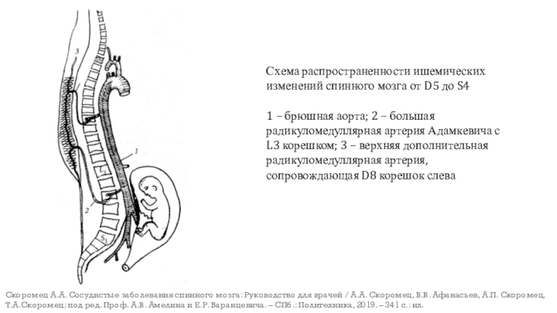 Артерия адамкевича. Артерия Адамкевича топография. Радикуломедуллярные артерии. Артерия Депрож Готтерона анатомия. Поражение артерии Адамкевича симптомы.