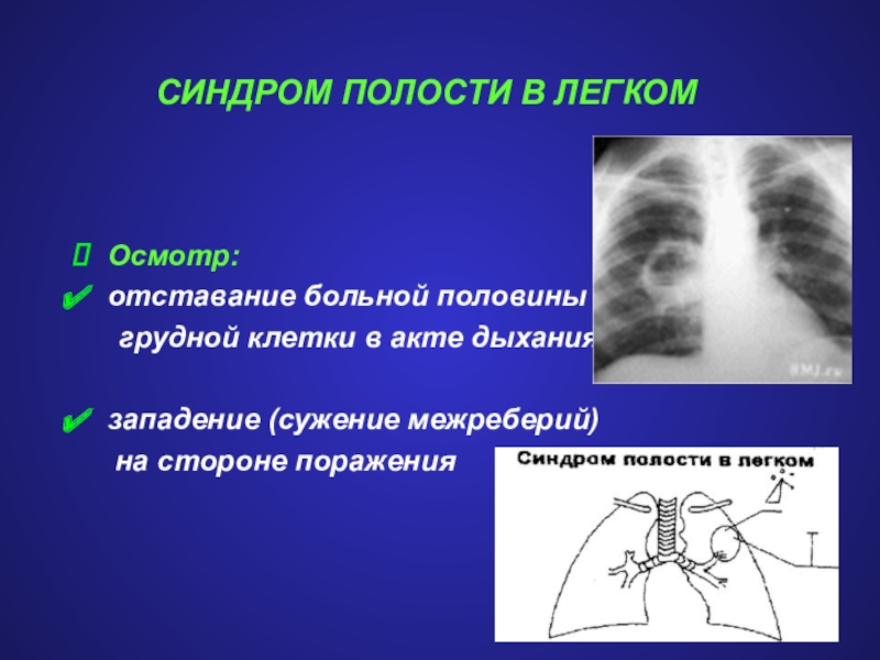 Полость в легком. Отставание грудной клетки в акте дыхания. Синдром полости в легком. Западение межреберных промежутков. Отставание половины грудной клетки в акте дыхания.