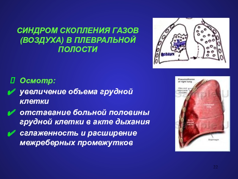 Скопление в плевральной полости. Скопление воздуха в плевральной полости. Синдром скопления газов в плевральной полости. Синдром скопления газа в плевральной полости. Скапливается воздух в грудной клетке.