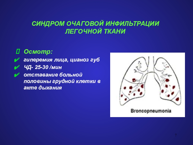 Инфильтрация тканей. Синдром инфильтрации легочной ткани. Синдром очаговой инфильтрации. Синдром воспалительной инфильтрации легочной ткани. Очаговая инфильтрация легочной ткани.