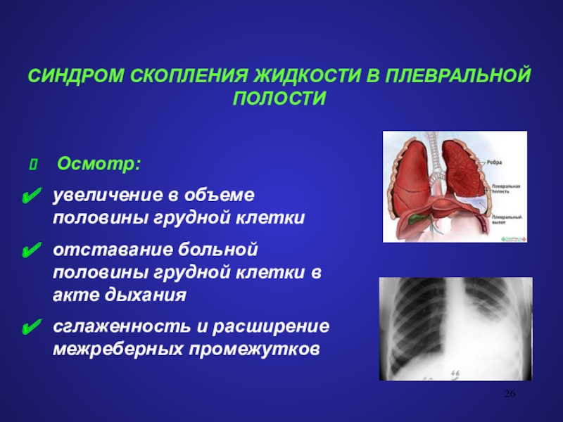 Синдром скопления жидкости. Синдром скопления жидкости в плевральной полости. Гидроторакс половина грудной клетки. Синдром скопления жидкости в плевральной полости диагностика. Синдром скопления жидкости в плевральной полости рентген.