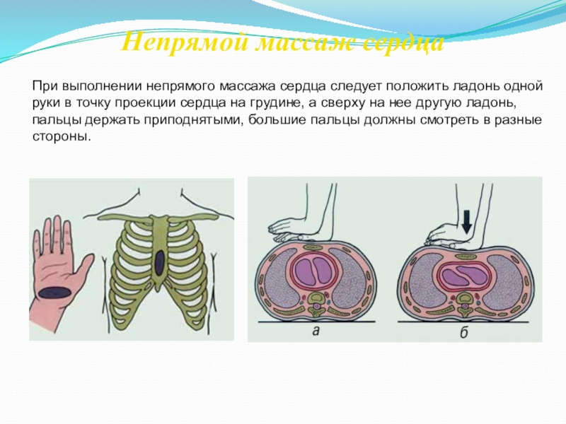 Непрямой массаж сердца аккредитация. Осложнения при проведении непрямого массажа сердца. Непрямой массаж сердца техника выполнения. Проекция сердца на грудную клетку. Расположение рук при непрямом массаже сердца правильное.