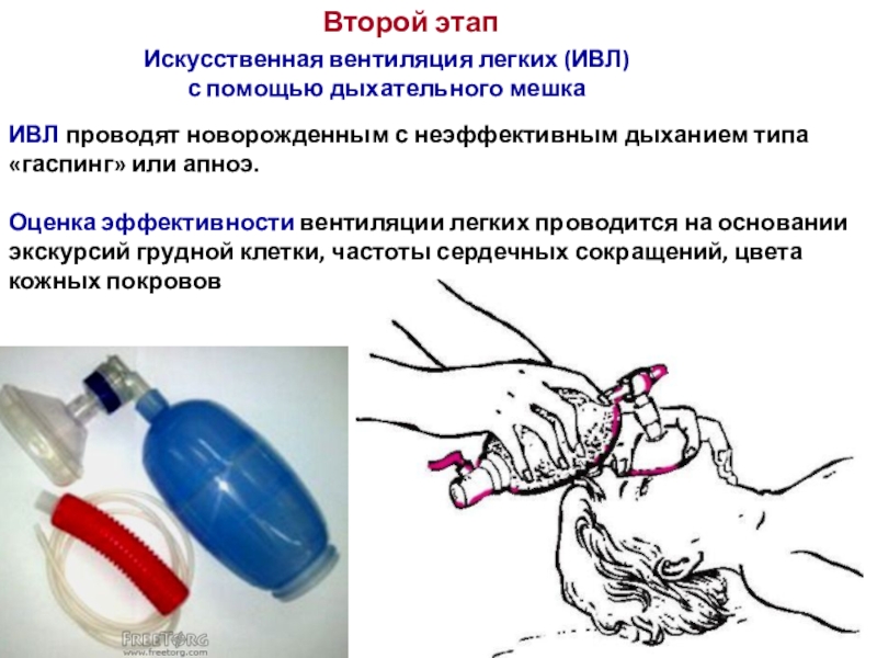 Искуственная вентиляция легких презентация