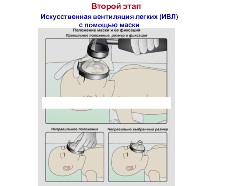 Произвести искусственную вентиляцию легких. Искусственная вентиляция лёгких. Как делать искусственную вентиляцию легких. Максимальная вентиляция легких норма. Какие бывают воздуховоды для ИВЛ.