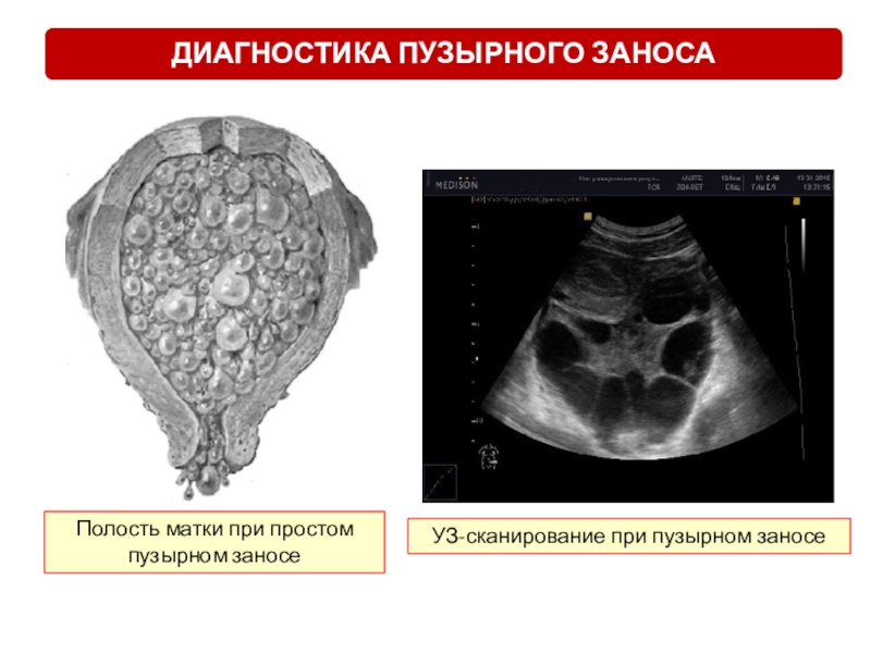 Пузырный занос презентация