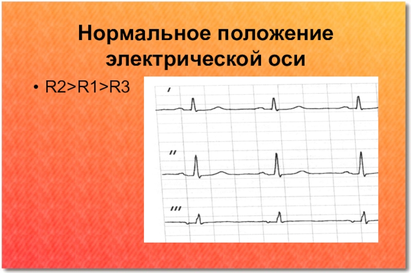 Нормальное положение. Нормальное положение электрической оси. Элс нормальное положение. Нарушения ритма БПН.