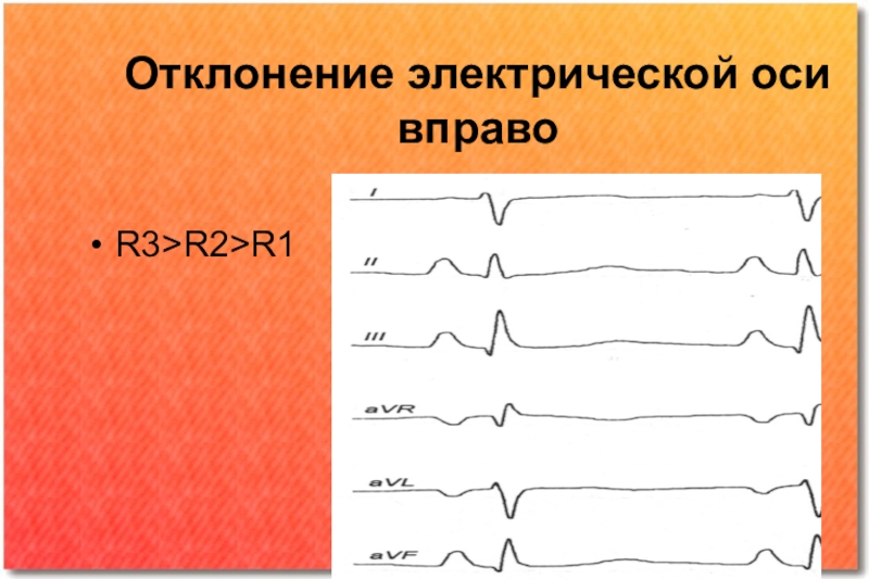 Отклонение электрической оси