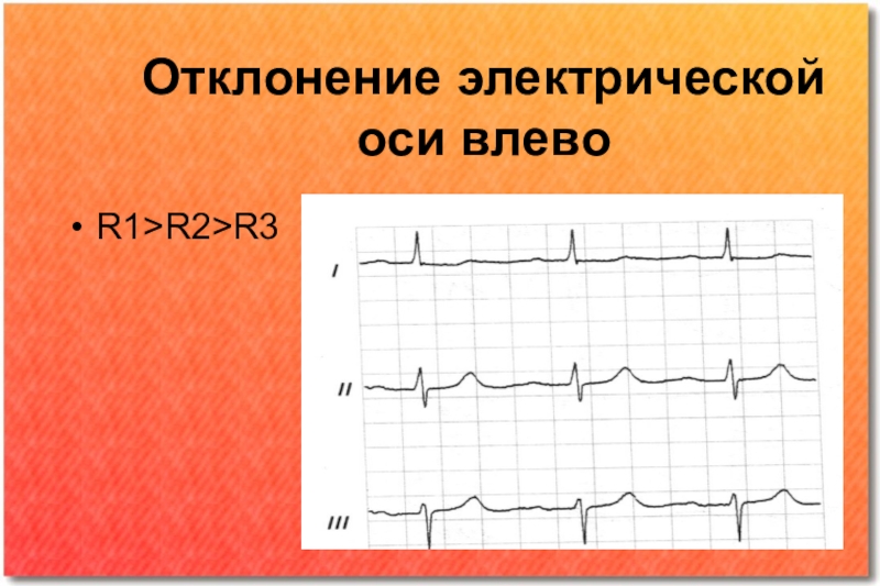 Отклонение правой электрической оси. Отклонение электрической оси. Отклонение оси влево на ЭКГ. Альтерация электрической оси. Электрическая ось сердца презентация.