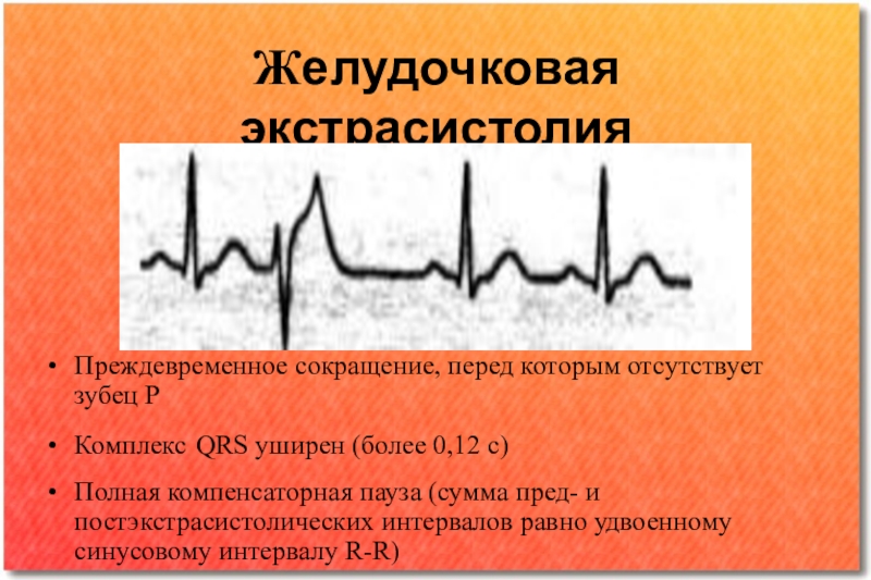 Р перед. Желудочковая экстрасистолия полная компенсаторная пауза. Желудочковые сокращения. Желудочковые нарушения ритма. Полная компенсаторная пауза при экстрасистолии.