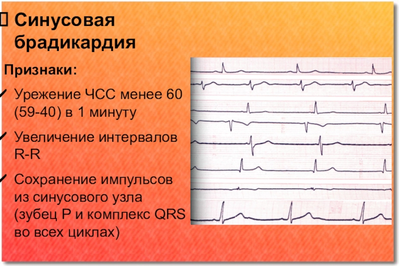 Синусовый ритм с чсс. Синусовая брадикардия ЧСС. Интервал RR при синусовой брадикардии:. Брадикардия синусового узла. Брадикардия это ЧСС менее.