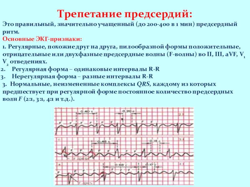 Трепетание предсердий карта вызова