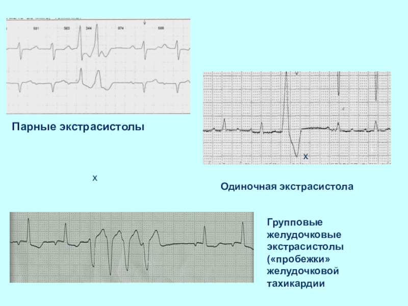 Желудочковые экстрасистолы презентация