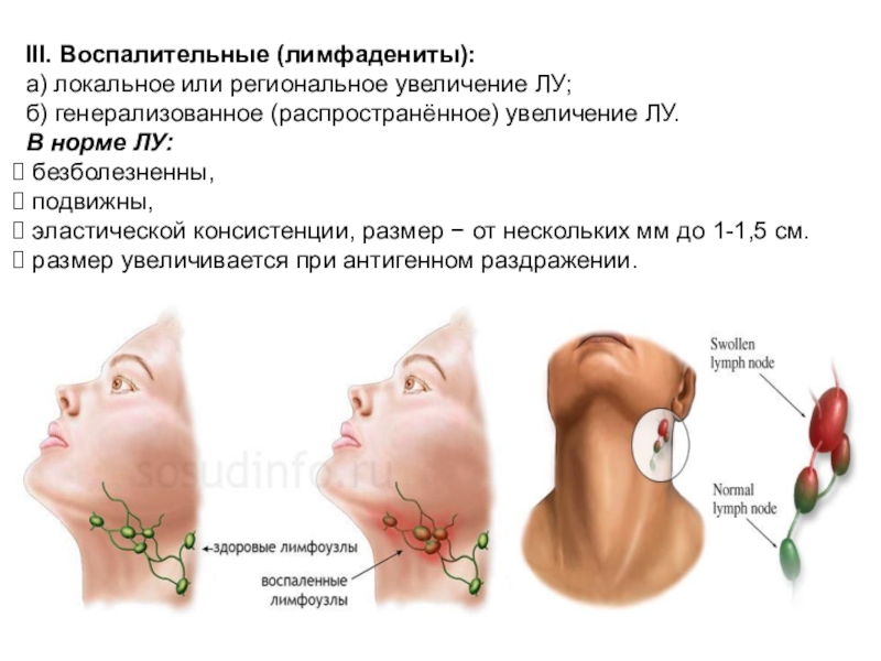 Лимфаденопатия лимфоузлов лечение