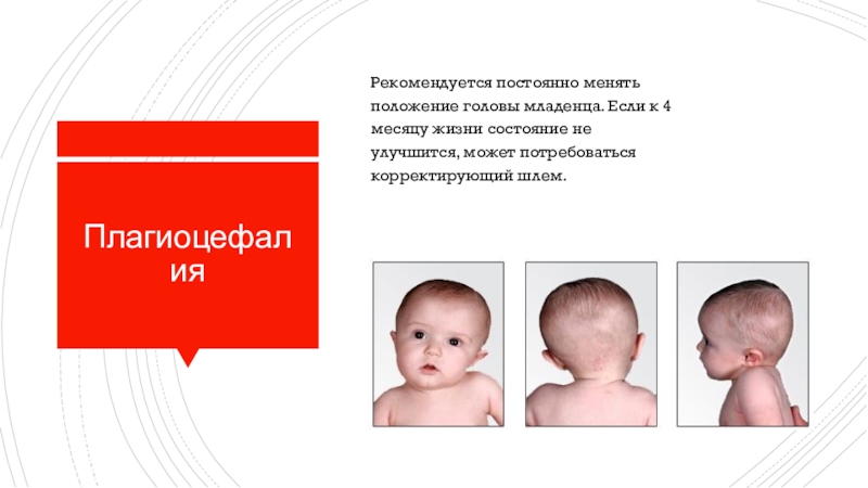 Мозг новорожденного норма. Строение головы у младенца новорожденного. Положение головы новорожденного. Форма головы у новорожденных.