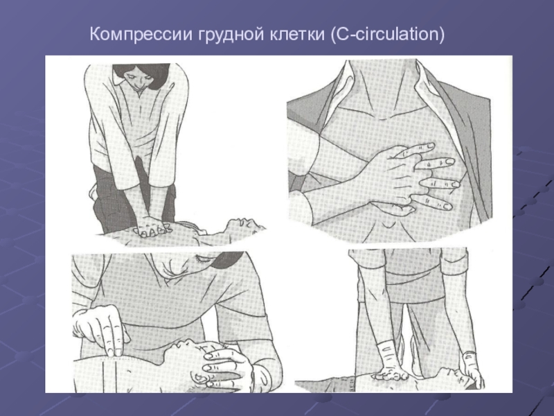 Компрессия грудной клетки. Компрессии грудной клетки c lah рисунок. Компрессия грудной клетки зачем. Как убрать компрессию в грудине.