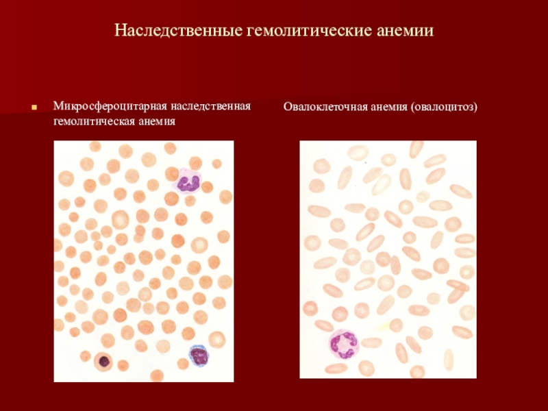 Гемолитическая анемия картина крови