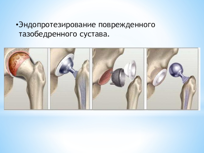 Эндопротезирование суставов презентация