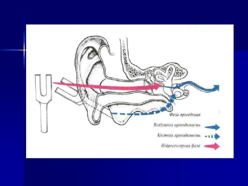 Костная проводимость. Исследование костной и воздушной проводимости звука. Исследование костной проводимости камертонами. Проба Ринне. Механизм воздушной и костной проводимости схема.