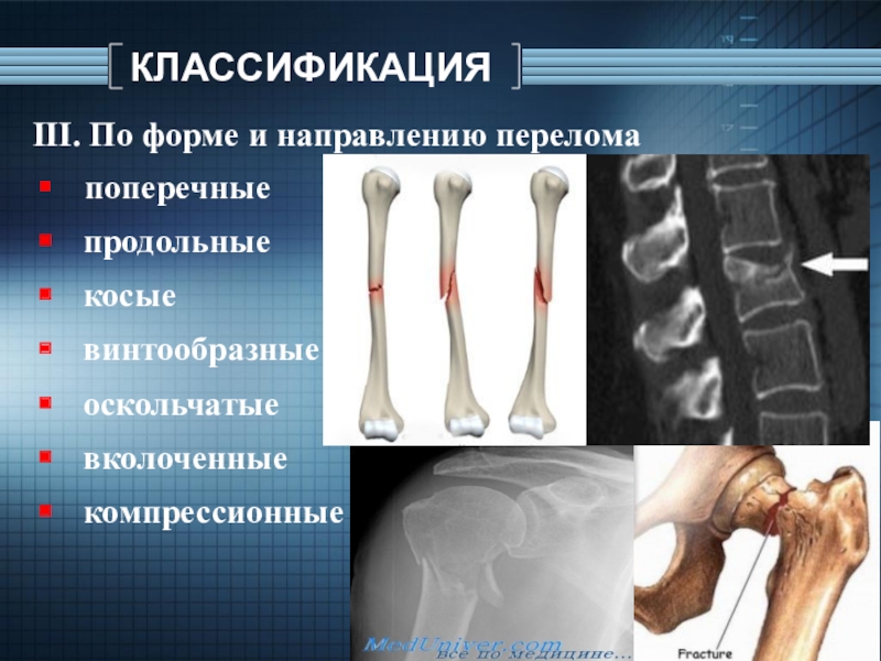 Поперечный перелом. Винтообразный перелом трубчатой кости. Переломы поперечные косые продольные. Поперечные и оскольчатые переломы.