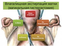 Влагалищная экстирпация матки (вагинальная гистерэктомия )