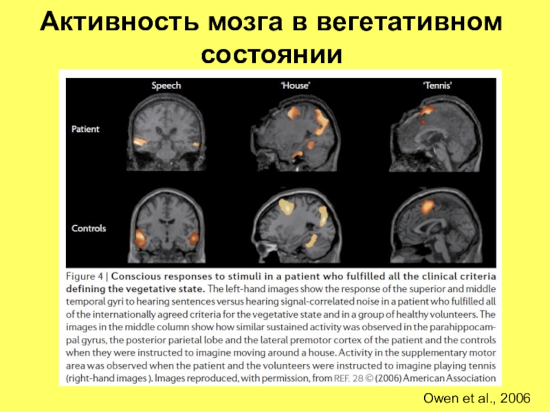 Время активного мозга. Активность мозга. Активность мозга на мрт. Мозг при вегетативном состоянии. Активный мозг.