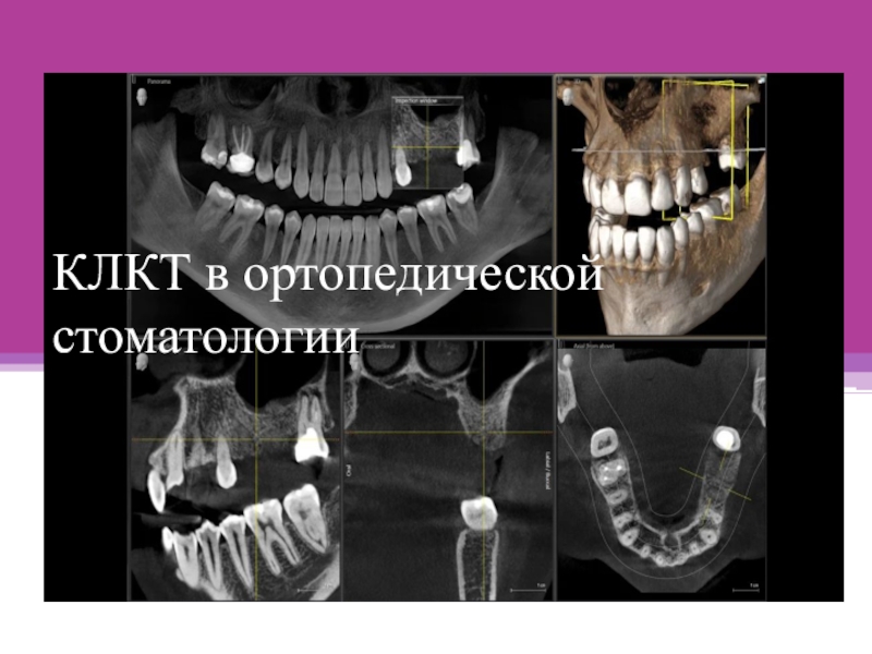 КЛКТ в ортопедической стоматологии
