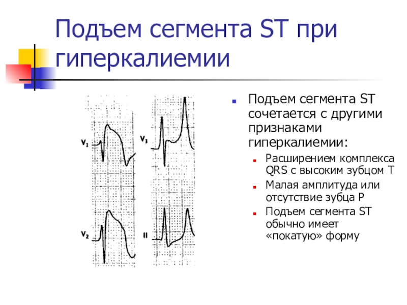 Конкордантный подъем сегмента. Подъем сегмента St на ЭКГ v3. Подъем сегмента St на ЭКГ В грудных отведениях. ЭКГ признаки гиперкалиемии ЭКГ. Подъем сегмента St вогнутой формы.