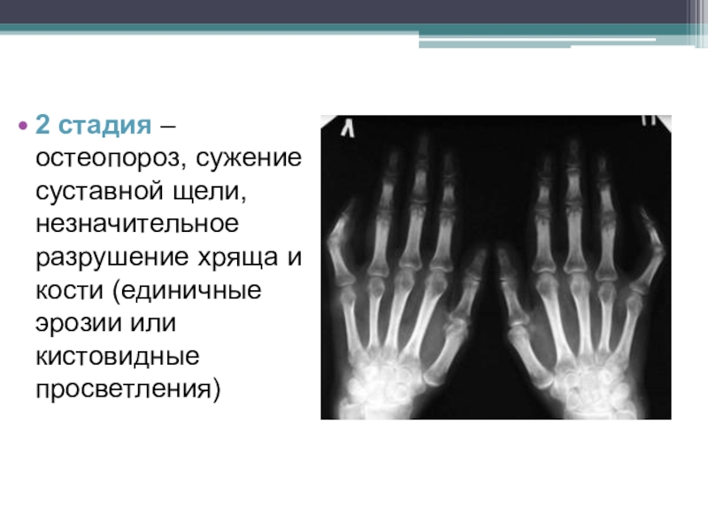 Ревматоидный артрит презентация